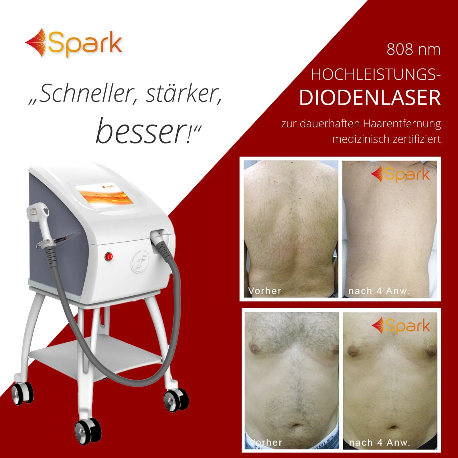 Laser-Haar-Wandel, Eindruck 4